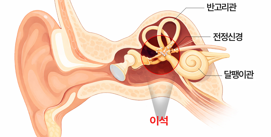 이석과 반고리관 — 귀 내부 전정기관 도해