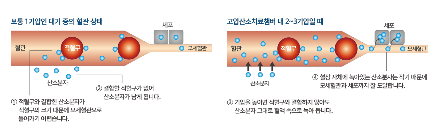 고압산소치료 원리 및 신체 영향 도해