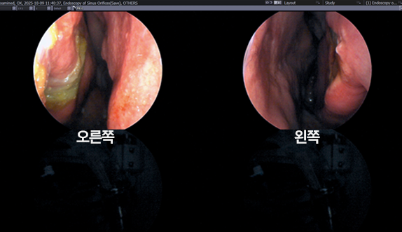 코콜이 수술 후 상태